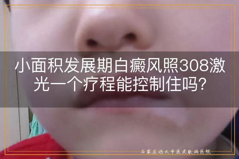 小面积发展期白癜风照308激光一个疗程能控制住吗？