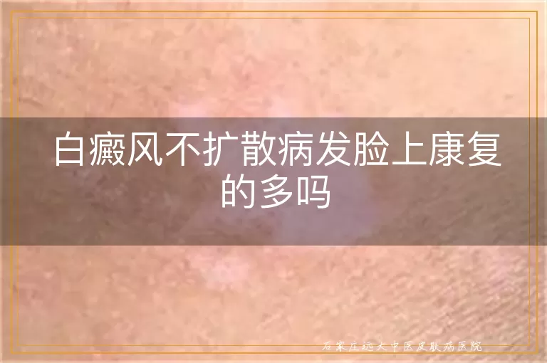 白癜风不扩散病发脸上康复的多吗