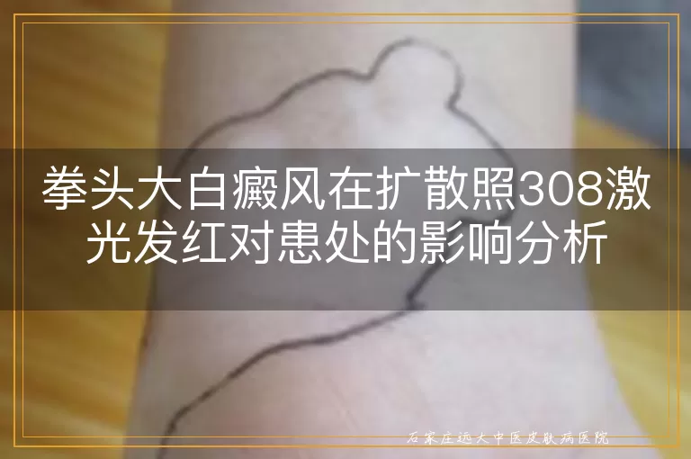 拳头大白癜风在扩散照308激光发红对患处的影响分析