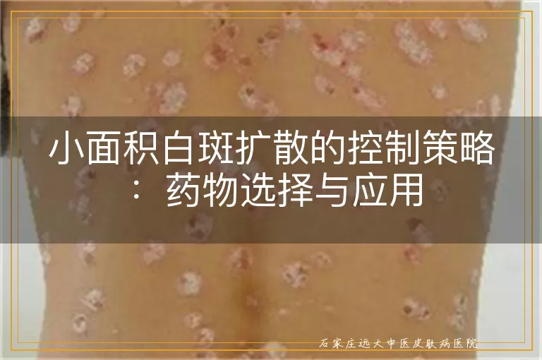 小面积白斑扩散的控制策略：药物选择与应用