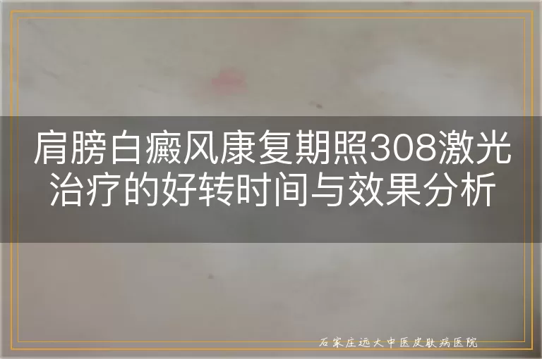 肩膀白癜风康复期照308激光治疗的好转时间与效果分析