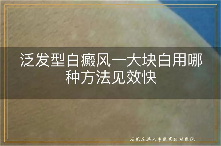 泛发型白癜风一大块白用哪种方法见效快