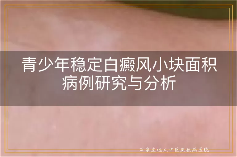 青少年稳定白癜风小块面积病例研究与分析