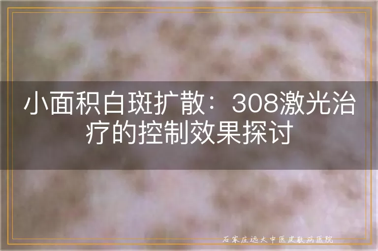 小面积白斑扩散：308激光治疗的控制效果探讨