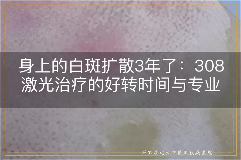 身上的白斑扩散3年了：308激光治疗的好转时间与专业解析