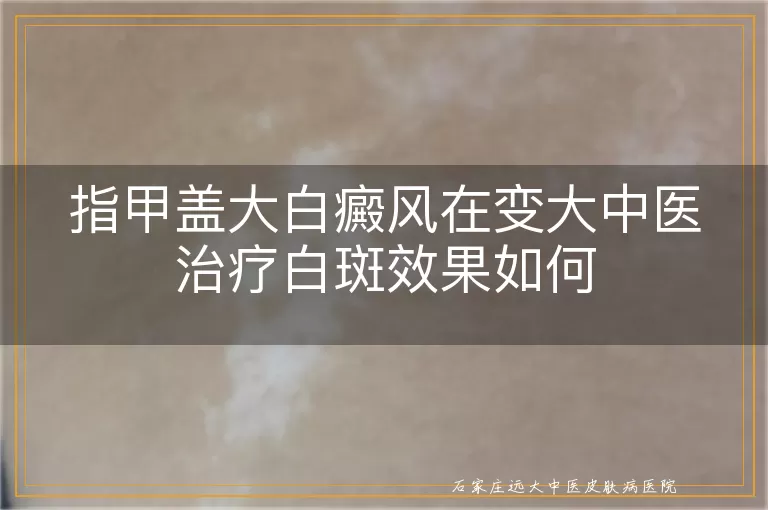 指甲盖大白癜风在变大中医治疗白斑效果如何