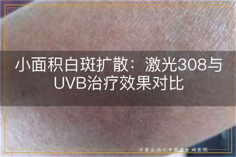 小面积白斑扩散：激光308与UVB治疗效果对比