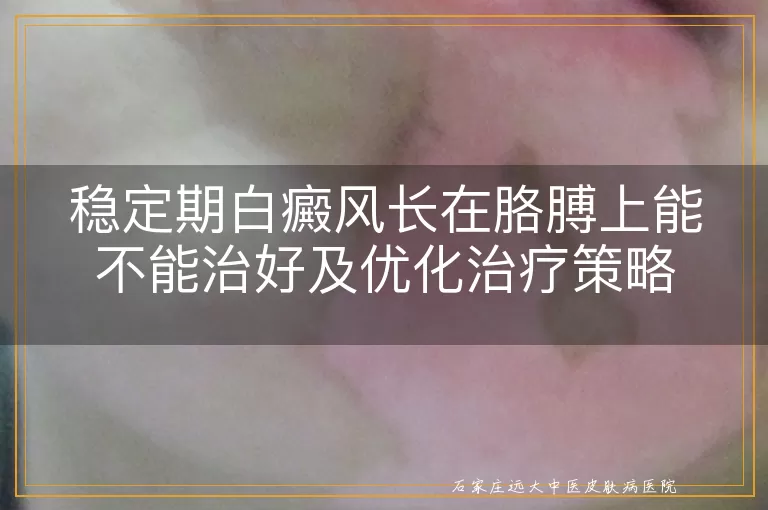 稳定期白癜风长在胳膊上能不能治好及优化治疗策略