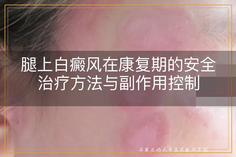 腿上白癜风在康复期的安全治疗方法与副作用控制