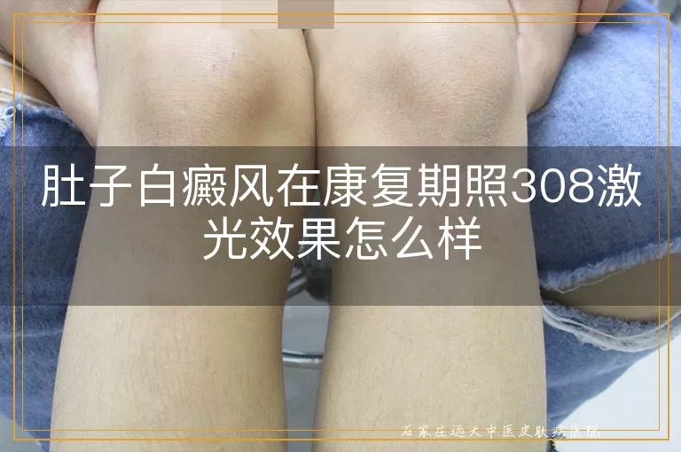 肚子白癜风在康复期照308激光效果怎么样