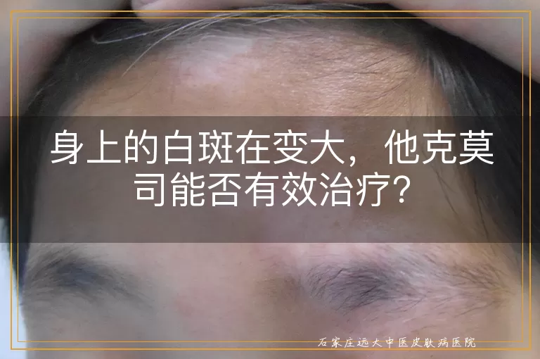 身上的白斑在变大，他克莫司能否有效治疗？