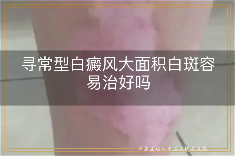 寻常型白癜风大面积白斑容易治好吗