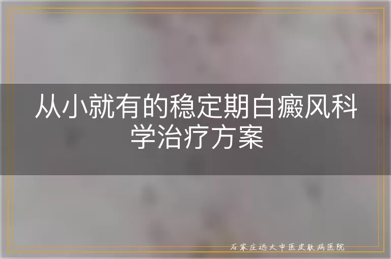 从小就有的稳定期白癜风科学治疗方案