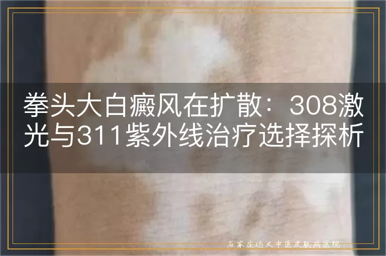 拳头大白癜风在扩散：308激光与311紫外线治疗选择探析