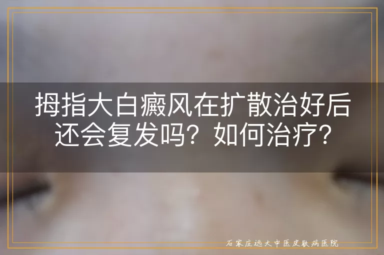 拇指大白癜风在扩散治好后还会复发吗？如何治疗？