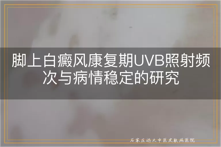 脚上白癜风康复期UVB照射频次与病情稳定的研究