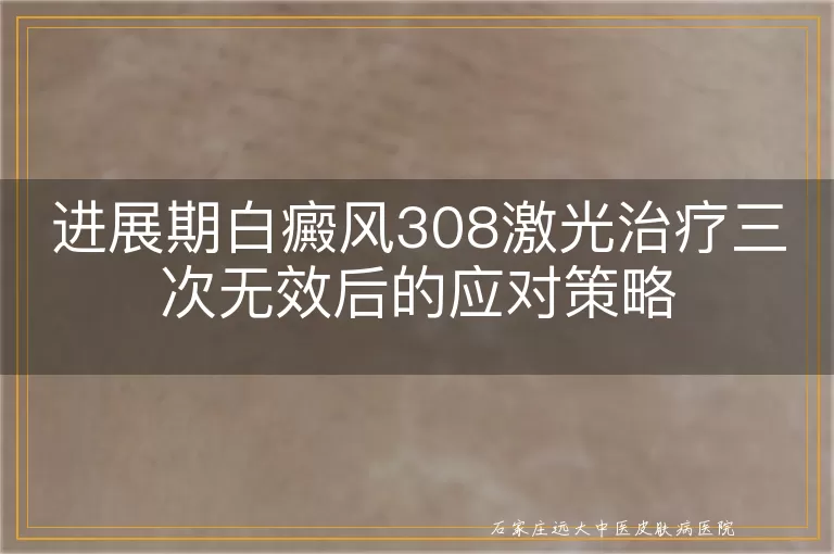 进展期白癜风308激光治疗三次无效后的应对策略