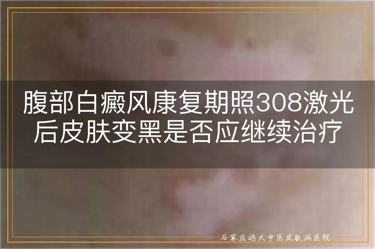 腹部白癜风康复期照308激光后皮肤变黑是否应继续治疗？