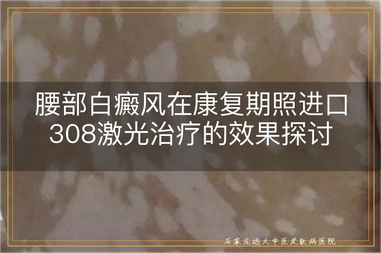 腰部白癜风在康复期照进口308激光治疗的效果探讨