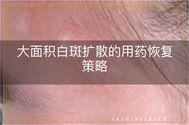 大面积白斑扩散的用药恢复策略