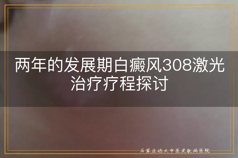 两年的发展期白癜风308激光治疗疗程探讨