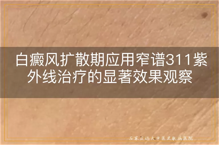 白癜风扩散期应用窄谱311紫外线治疗的显著效果观察