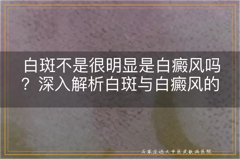 白斑不是很明显是白癜风吗？深入解析白斑与白癜风的关联