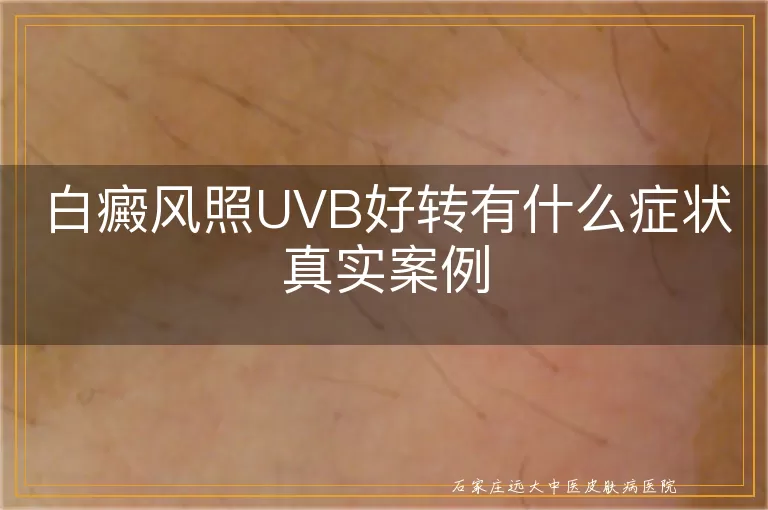 白癜风照UVB好转有什么症状真实案例