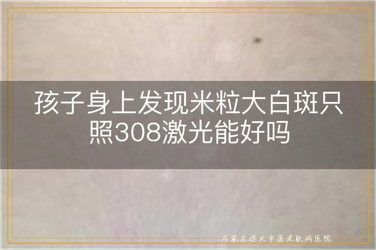 孩子身上发现米粒大白斑只照308激光能好吗