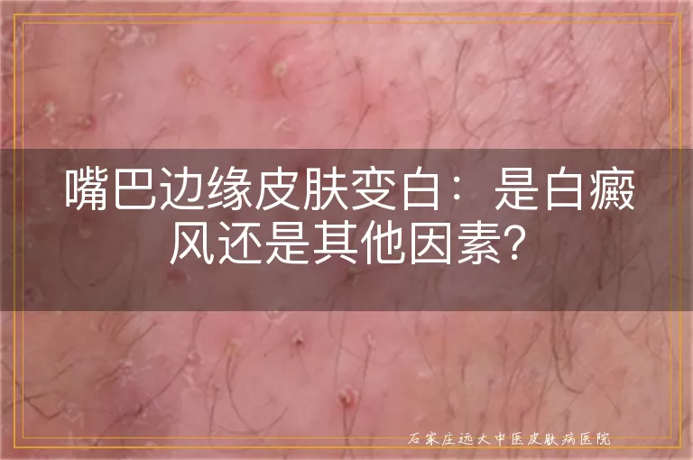 嘴巴边缘皮肤变白：是白癜风还是其他因素？