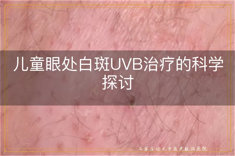 儿童眼处白斑UVB治疗的科学探讨