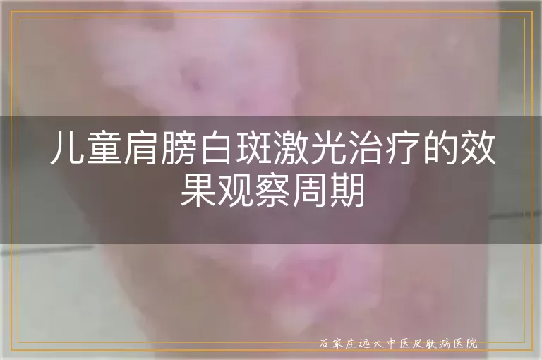 儿童肩膀白斑激光治疗的效果观察周期