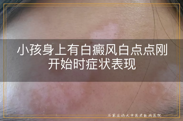 小孩身上有白癜风白点点刚开始时症状表现