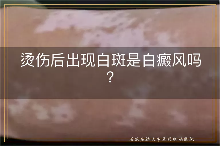 烫伤后出现白斑是白癜风吗？