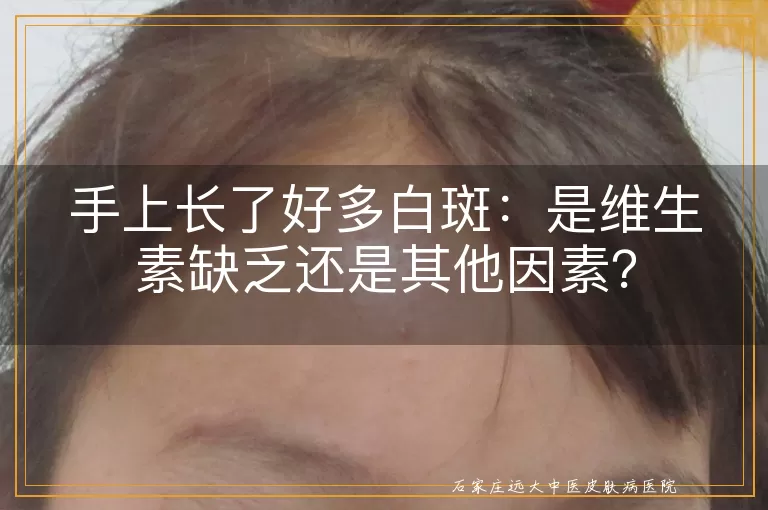 手上长了好多白斑：是维生素缺乏还是其他因素？