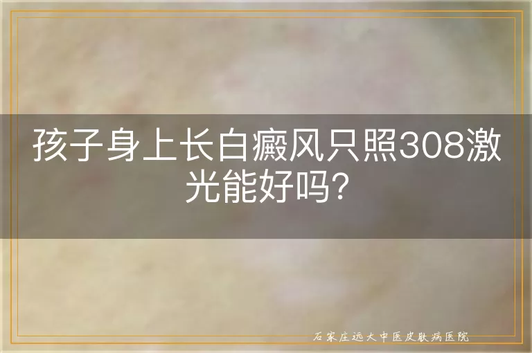 孩子身上长白癜风只照308激光能好吗？