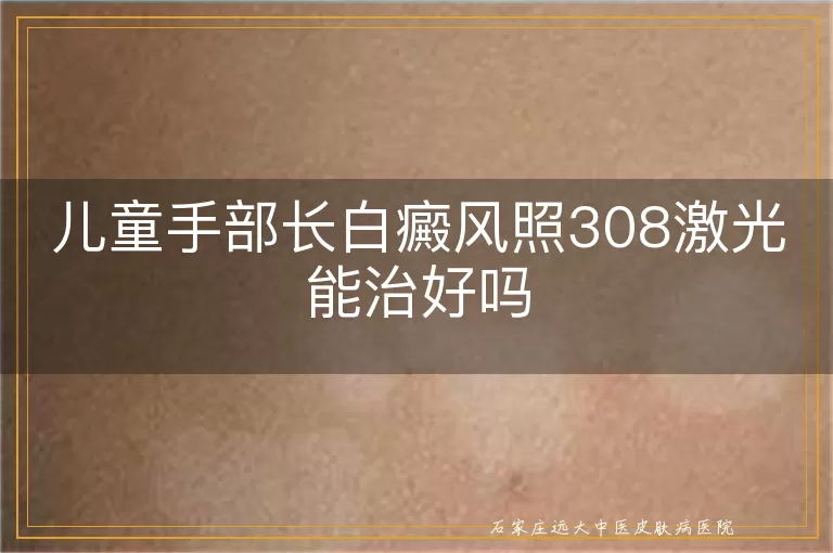 儿童手部长白癜风照308激光能治好吗