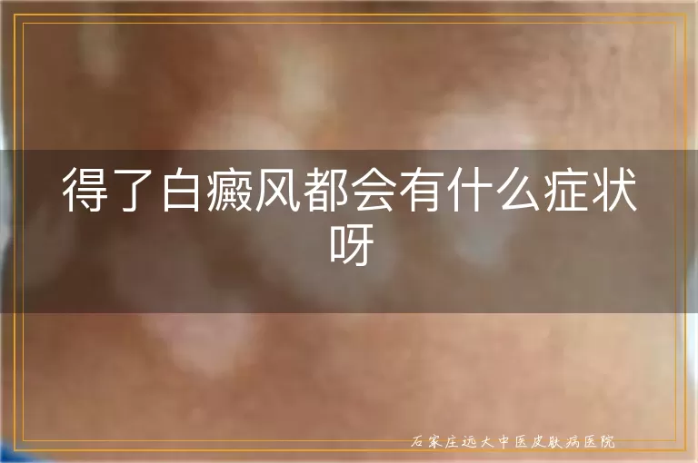 得了白癜风都会有什么症状呀