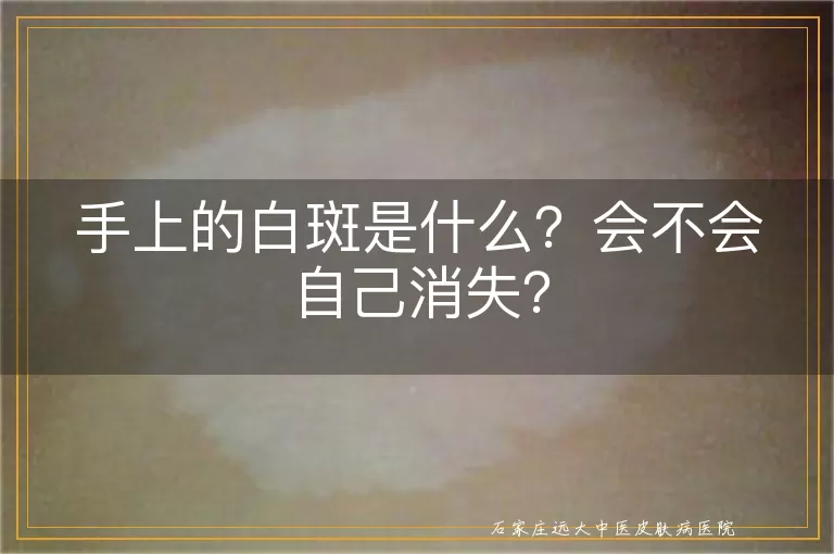 手上的白斑是什么？会不会自己消失？