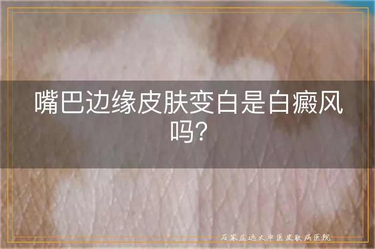 嘴巴边缘皮肤变白是白癜风吗？