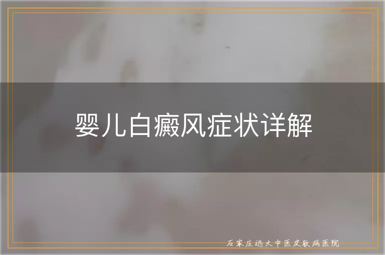 婴儿白癜风症状详解