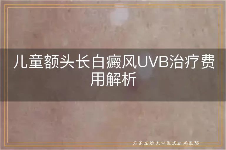 儿童额头长白癜风UVB治疗费用解析