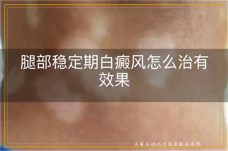 腿部稳定期白癜风怎么治有效果