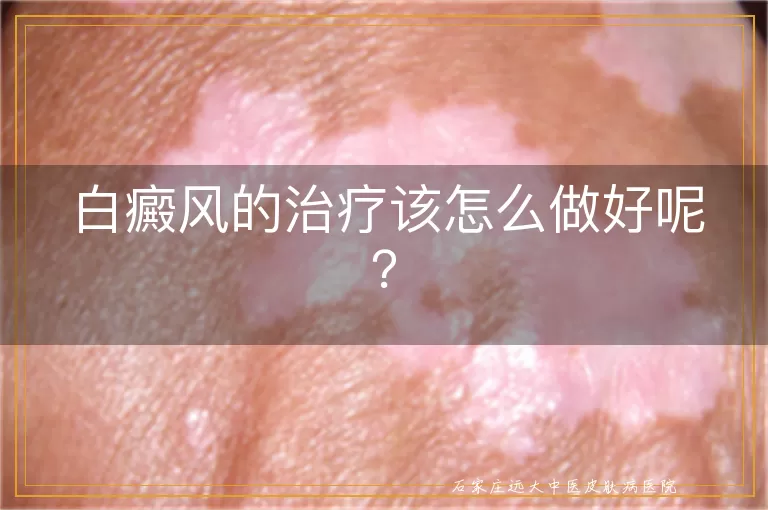 白癜风的治疗该怎么做好呢？