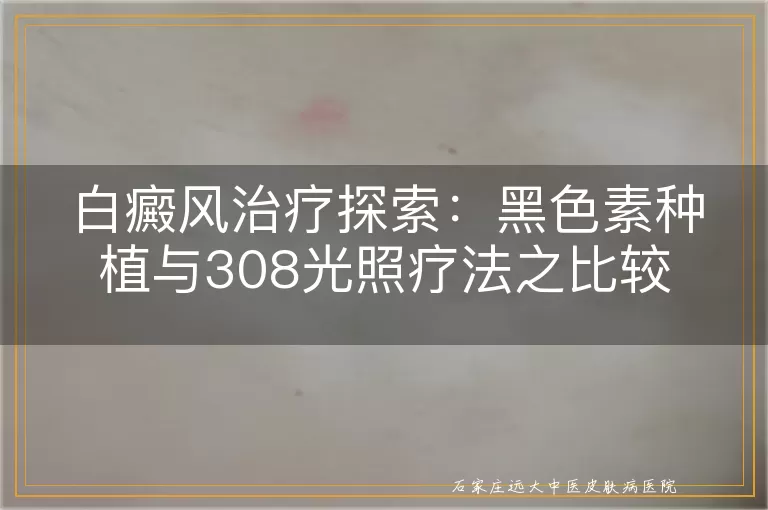 白癜风治疗探索：黑色素种植与308光照疗法之比较