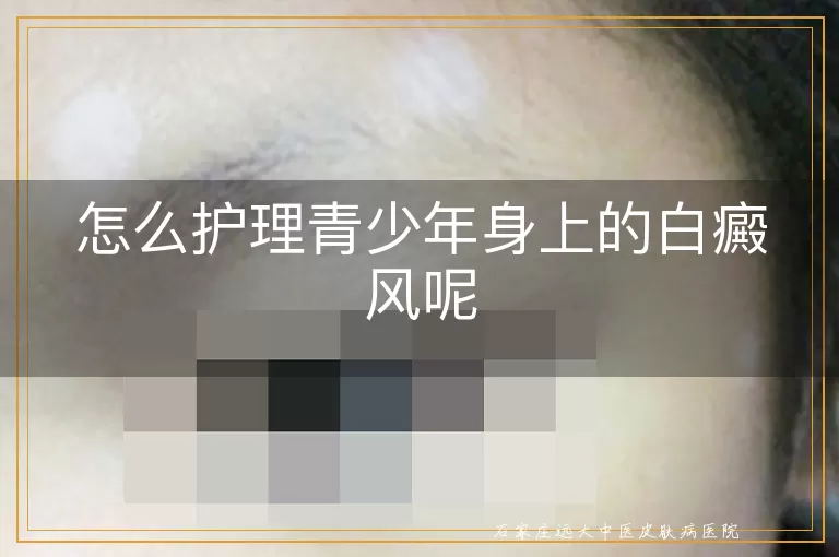 怎么护理青少年身上的白癜风呢