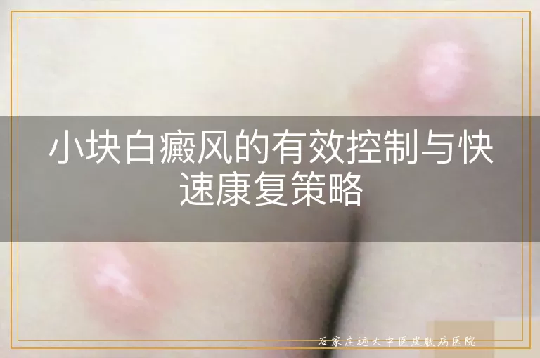 小块白癜风的有效控制与快速康复策略