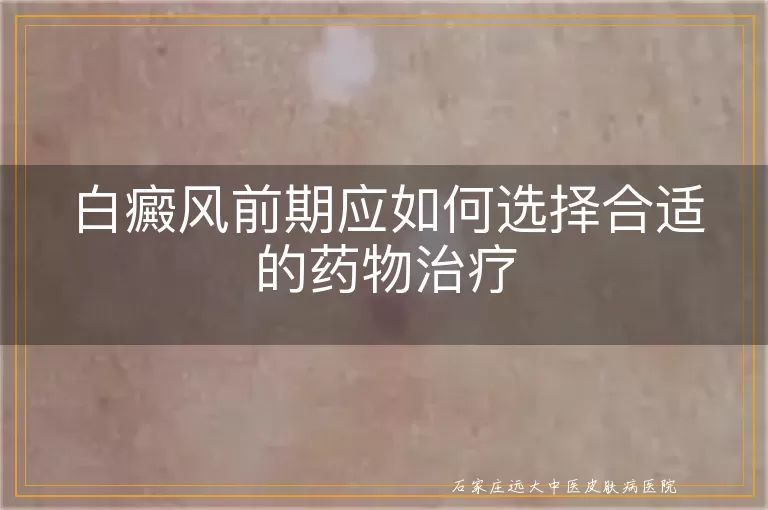 白癜风前期应如何选择合适的药物治疗