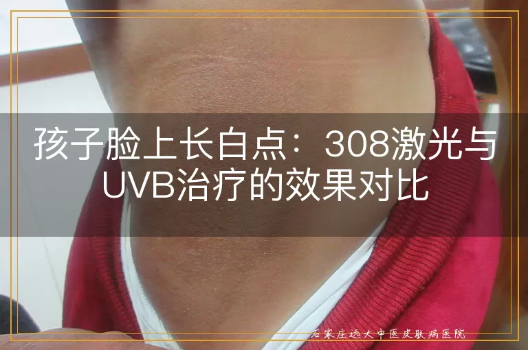 孩子脸上长白点：308激光与UVB治疗的效果对比