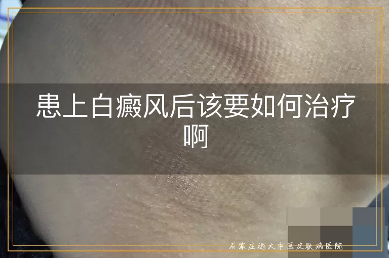 患上白癜风后该要如何治疗啊